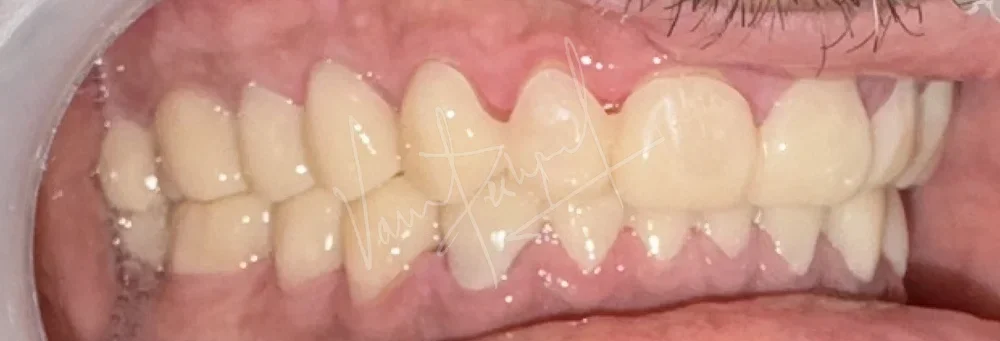 FMR using Zirconia Prosthesis - Image 13