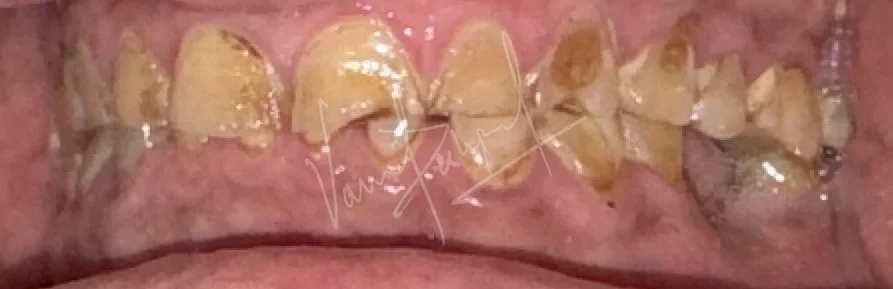 FMR using Zirconia Prosthesis - Image 3