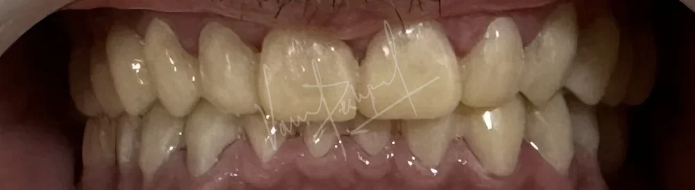 FMR using Zirconia Prosthesis - Image 6