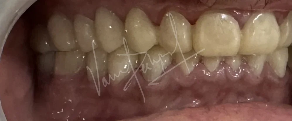FMR using Zirconia Prosthesis - Image 7