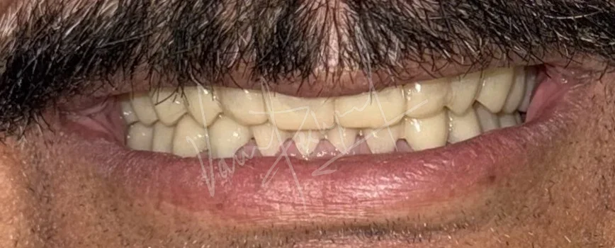 FMR using Zirconia Prosthesis - Image 9