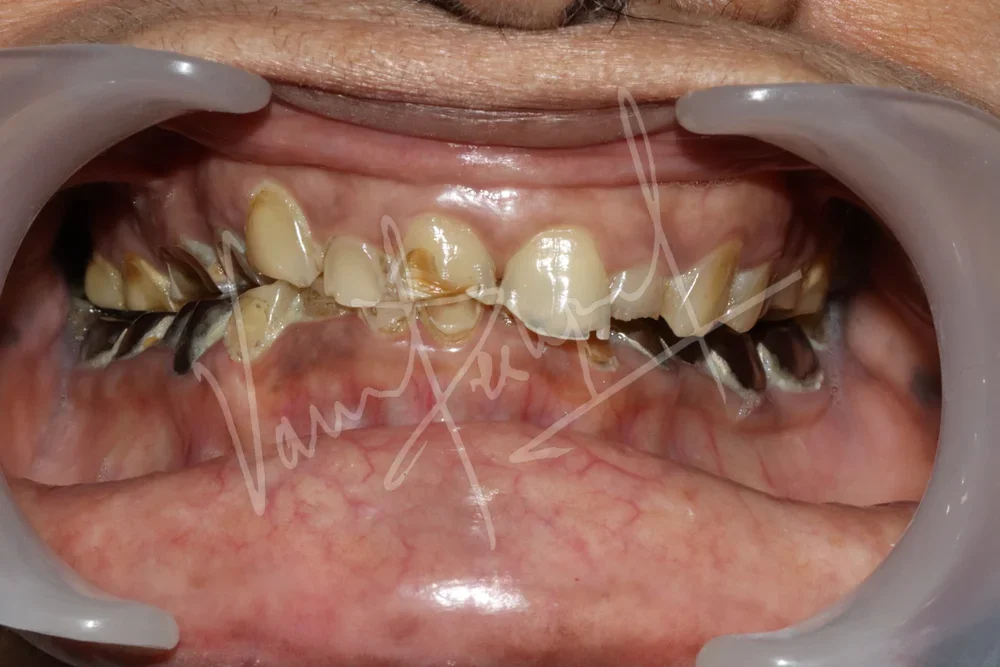 FMR with Metal Ceramic Prosthesis - Image 1