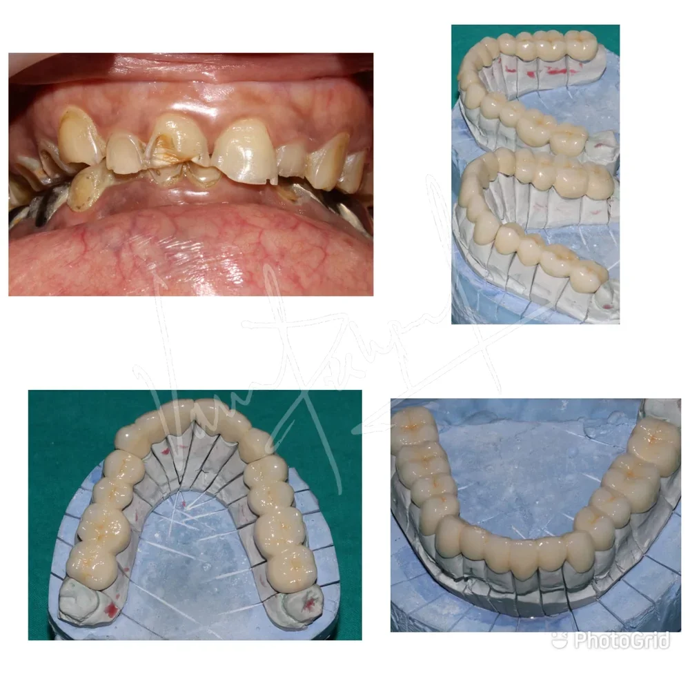 FMR with Metal Ceramic Prosthesis - Image 2