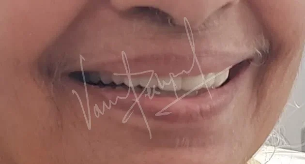 FMR with Metal Ceramic Prosthesis