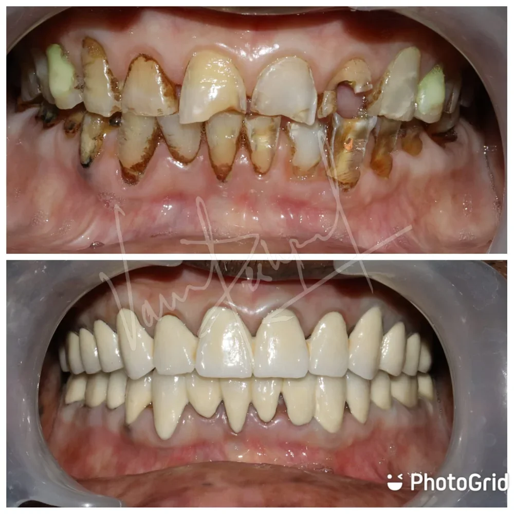 FMR with Porcelain-Fused-to-Metal Prosthesis
