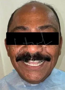 FMR with Porcelain-Fused-to-Metal Prosthesis DB - Image 2