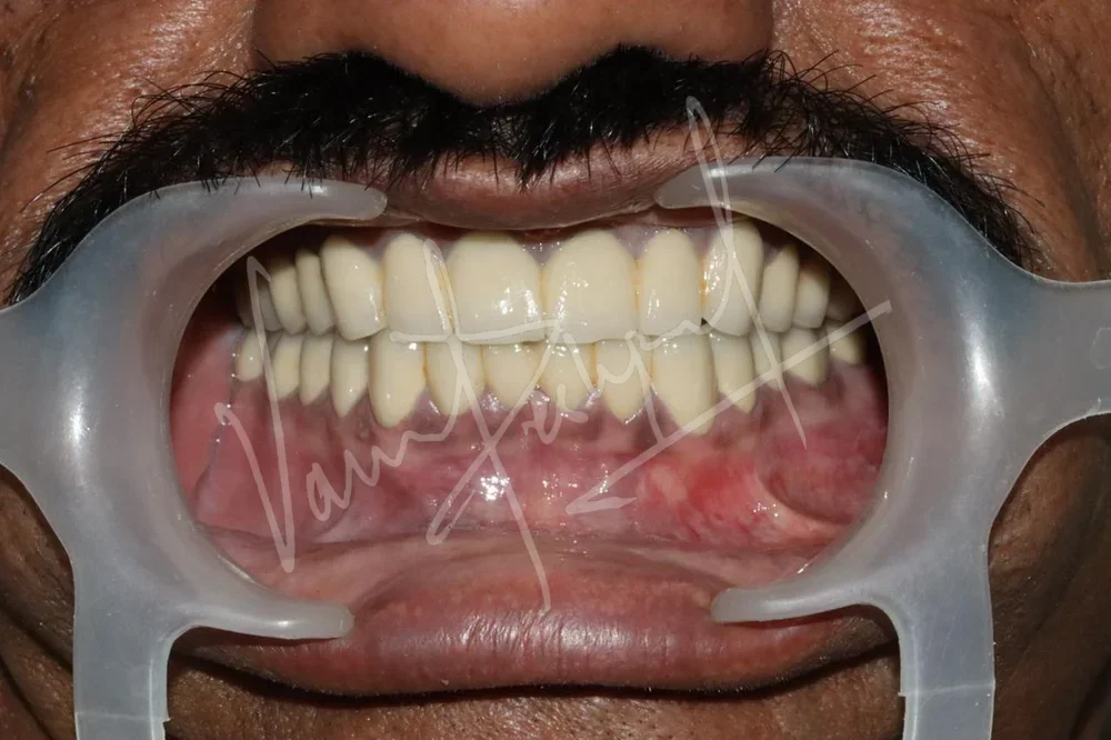 FMR with Porcelain-Fused-to-Metal Prosthesis DB - Image 5