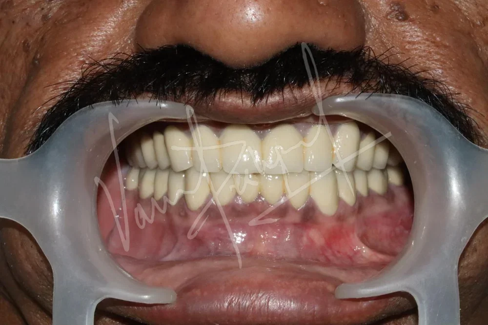 FMR with Porcelain-Fused-to-Metal Prosthesis DB - Image 8