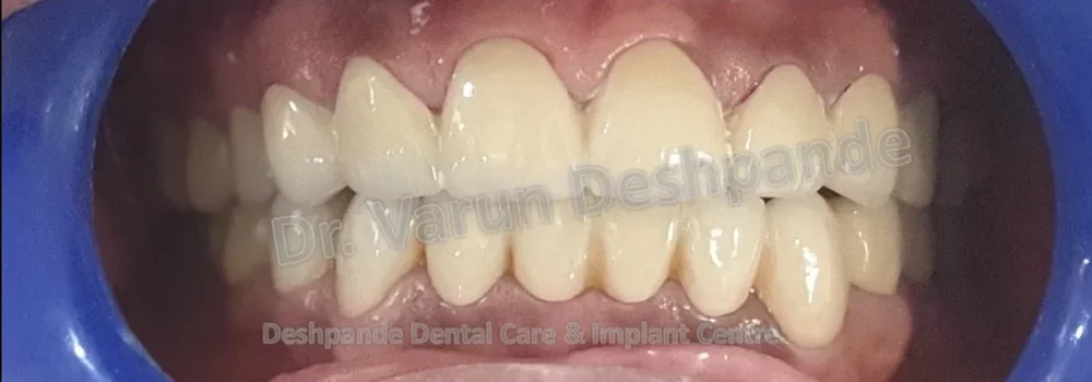 FMR with Porcelain-Fused-to-Metal Prosthesis