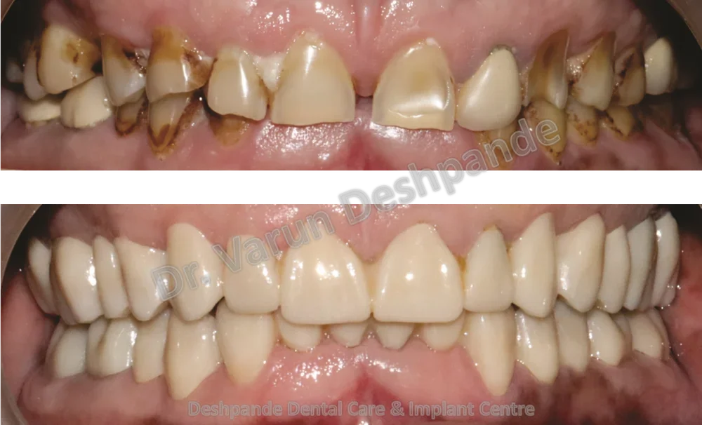Before and after full mouth rehabilitation