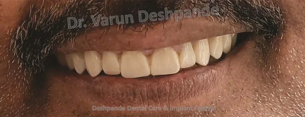 Full Mouth Rehabilitation using All Ceramic Prosthesis