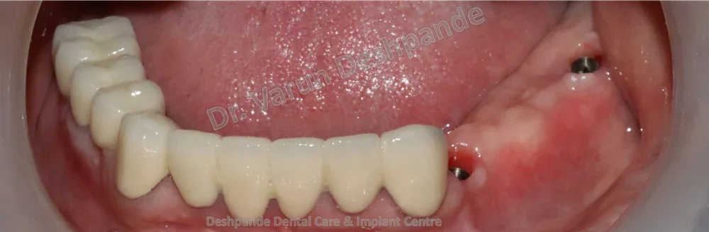 Full Mouth Rehabilitation using Dental Implants and Crown and Bridge - Image 10