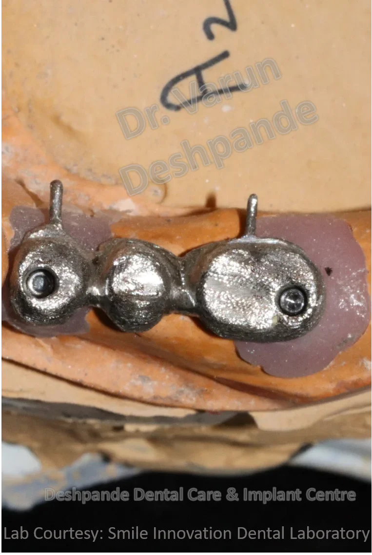 Full Mouth Rehabilitation using Dental Implants and Crown and Bridge - Image 11