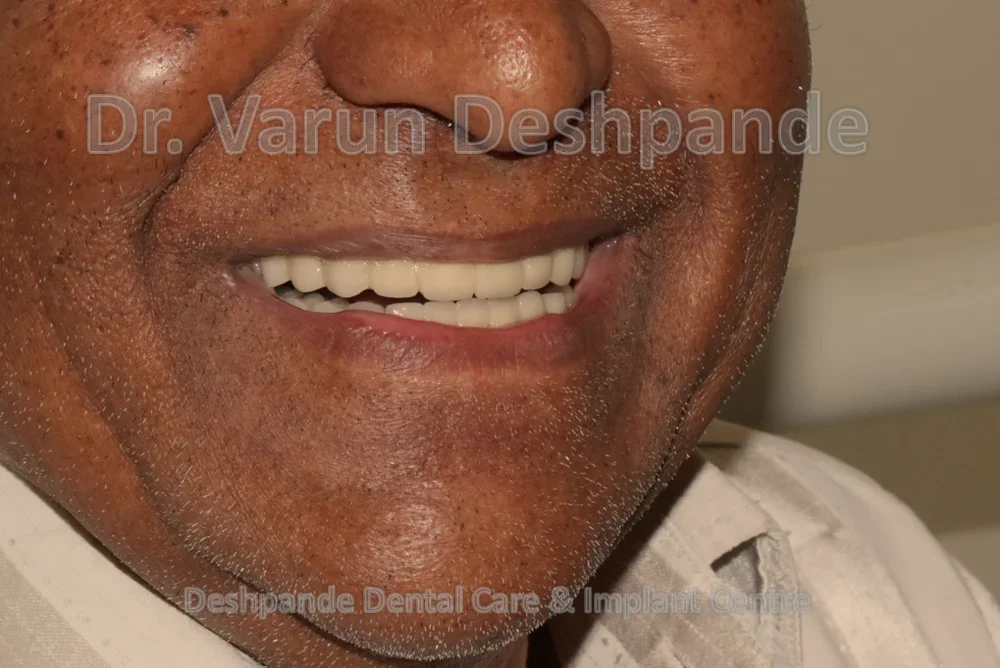 Full Mouth Rehabilitation using Dental Implants and Crown and Bridge