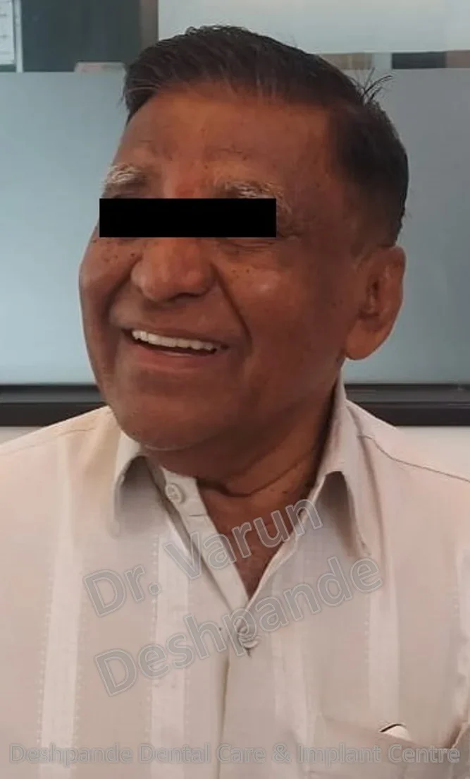 Full Mouth Rehabilitation using Dental Implants and Crown and Bridge - Image 14