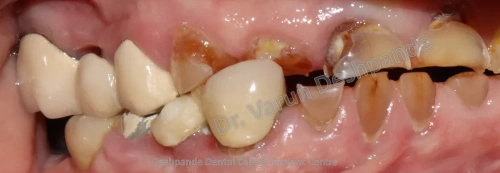 Full Mouth Rehabilitation using Dental Implants and Crown and Bridge - Image 2