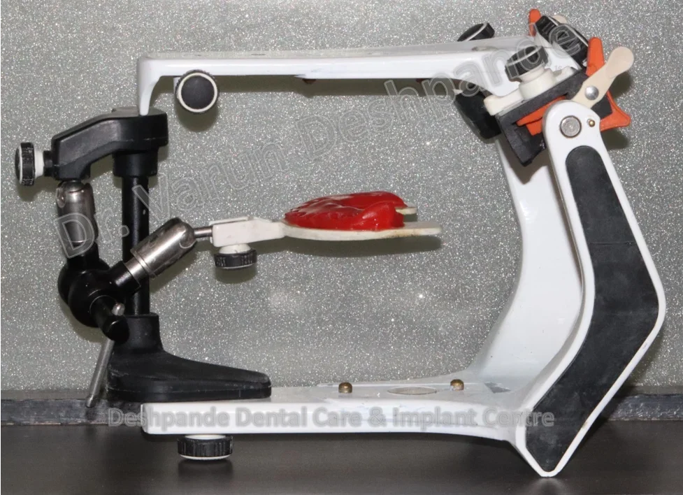 Full Mouth Rehabilitation using Dental Implants and Crown and Bridge - Image 6