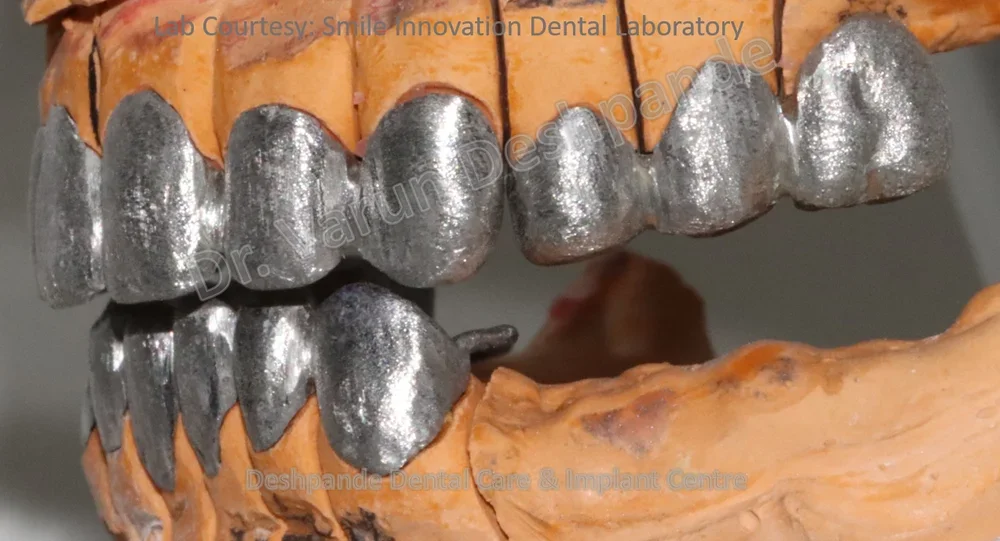 Full Mouth Rehabilitation using Dental Implants and Crown and Bridge - Image 8
