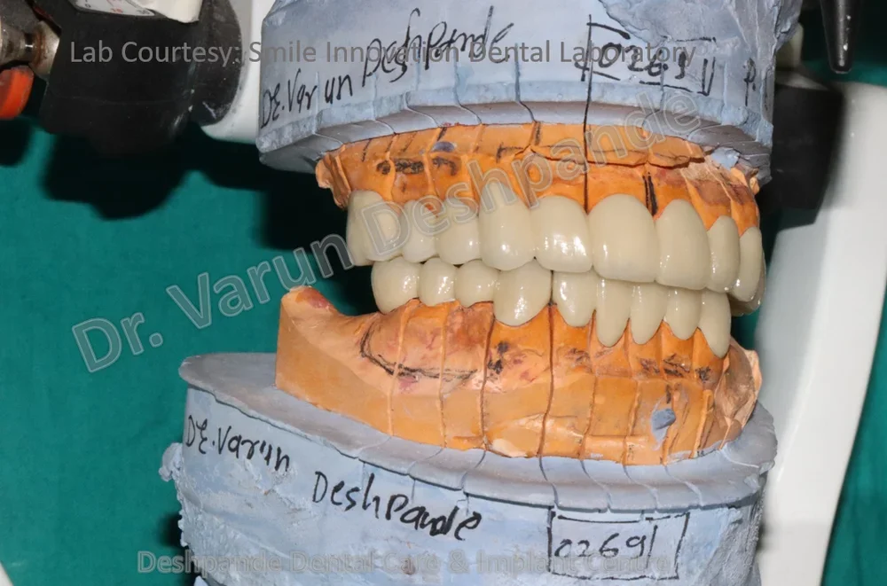 Full Mouth Rehabilitation using Dental Implants and Crown and Bridge - Image 9