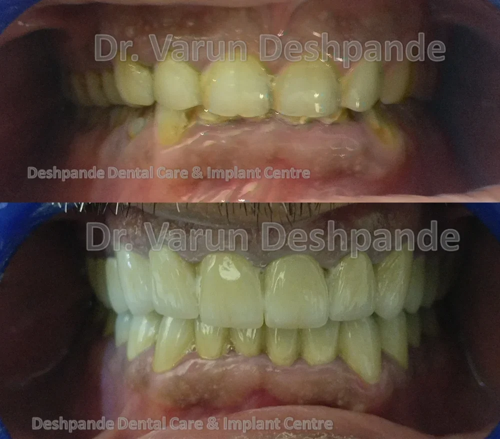 Full Mouth Rehabilitation using Metal Ceramic Prosthesis - Image 2