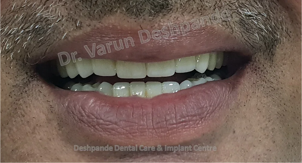 Full Mouth Rehabilitation using Metal Ceramic Prosthesis
