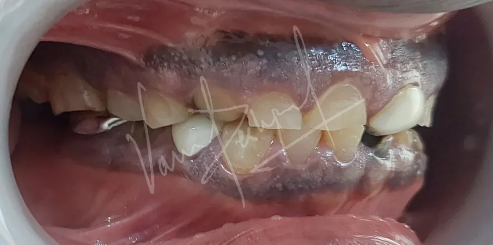 Full Mouth Rehabilitation using Metal Ceramic Prosthesis BD - Image 1