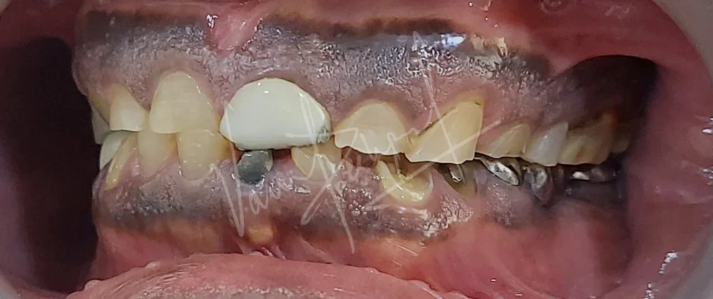 Full Mouth Rehabilitation using Metal Ceramic Prosthesis BD - Image 2