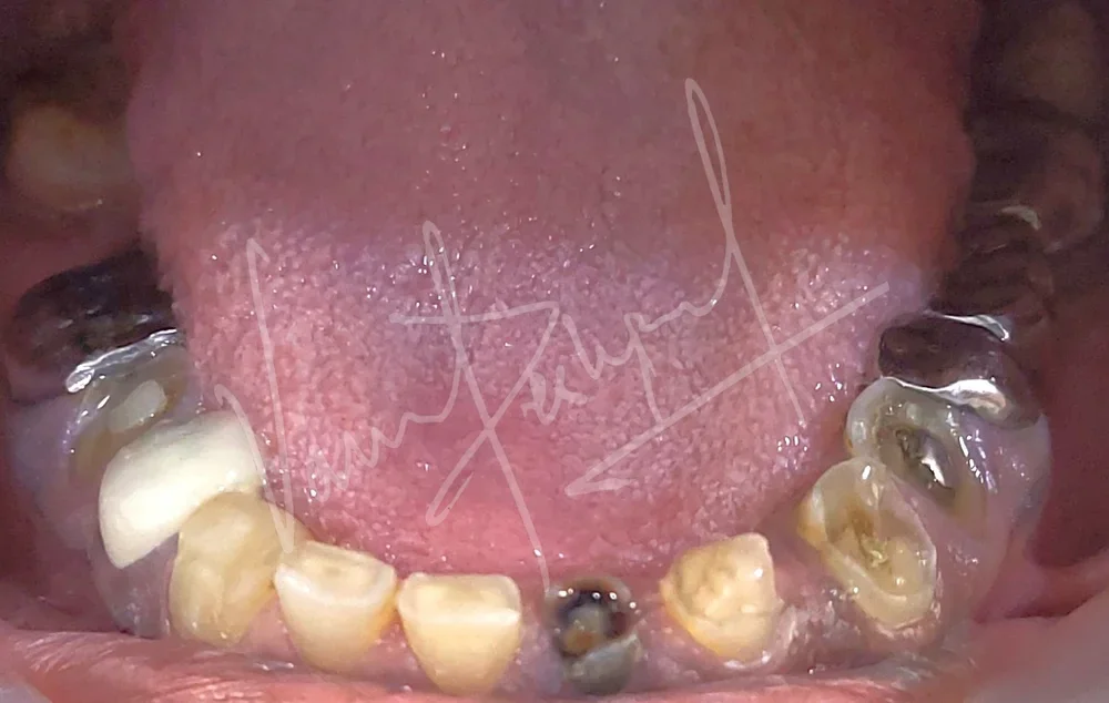 Full Mouth Rehabilitation using Metal Ceramic Prosthesis BD - Image 3