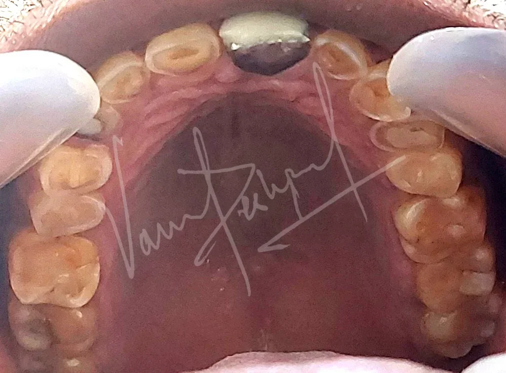Full Mouth Rehabilitation using Metal Ceramic Prosthesis BD - Image 4