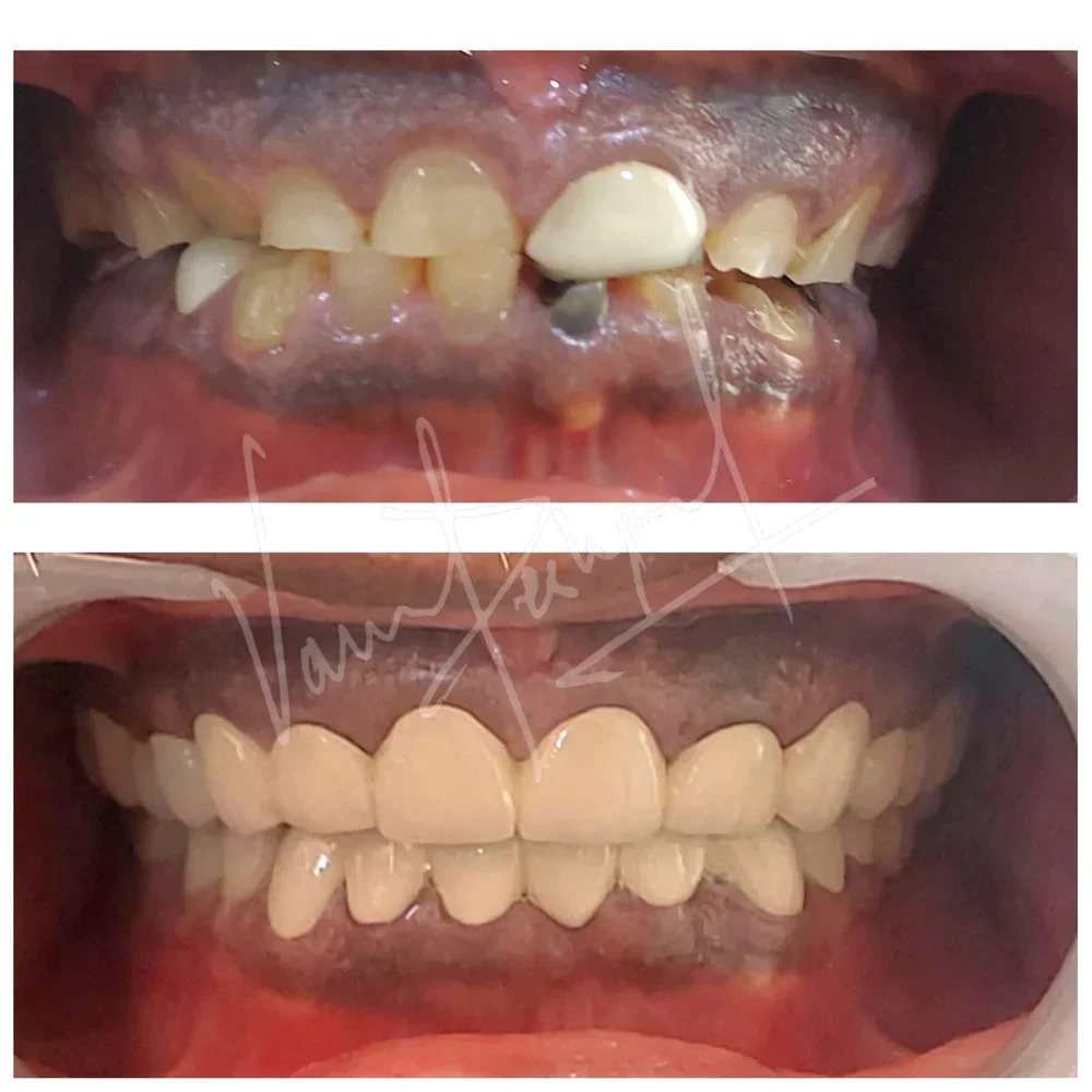 Full Mouth Rehabilitation using Metal Ceramic Prosthesis BD - Image 5