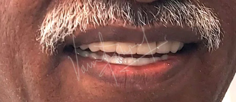 Full Mouth Rehabilitation using Metal Ceramic Prosthesis