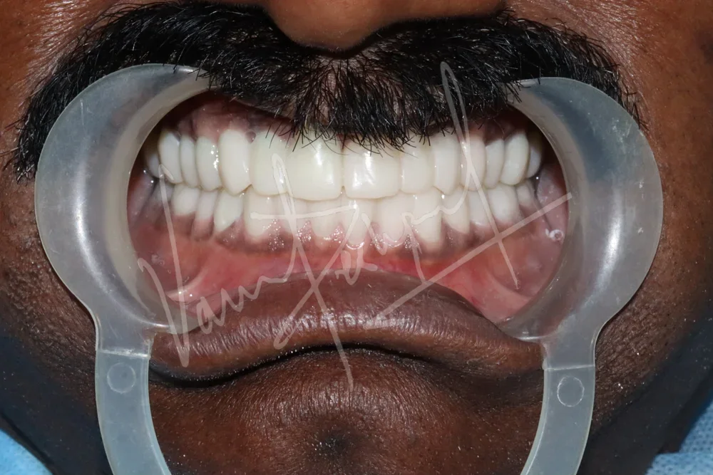 Full Mouth Rehabilitation using Zirconia Monolithic Prosthesis - Image 1