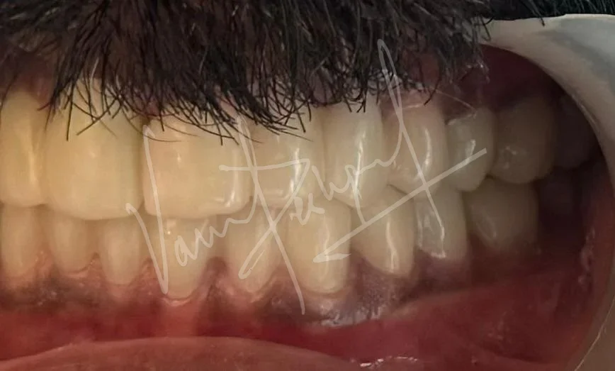 Full Mouth Rehabilitation using Zirconia Monolithic Prosthesis - Image 10
