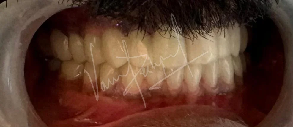 Full Mouth Rehabilitation using Zirconia Monolithic Prosthesis - Image 11
