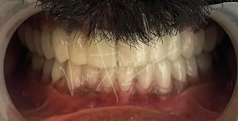 Full Mouth Rehabilitation using Zirconia Monolithic Prosthesis - Image 12