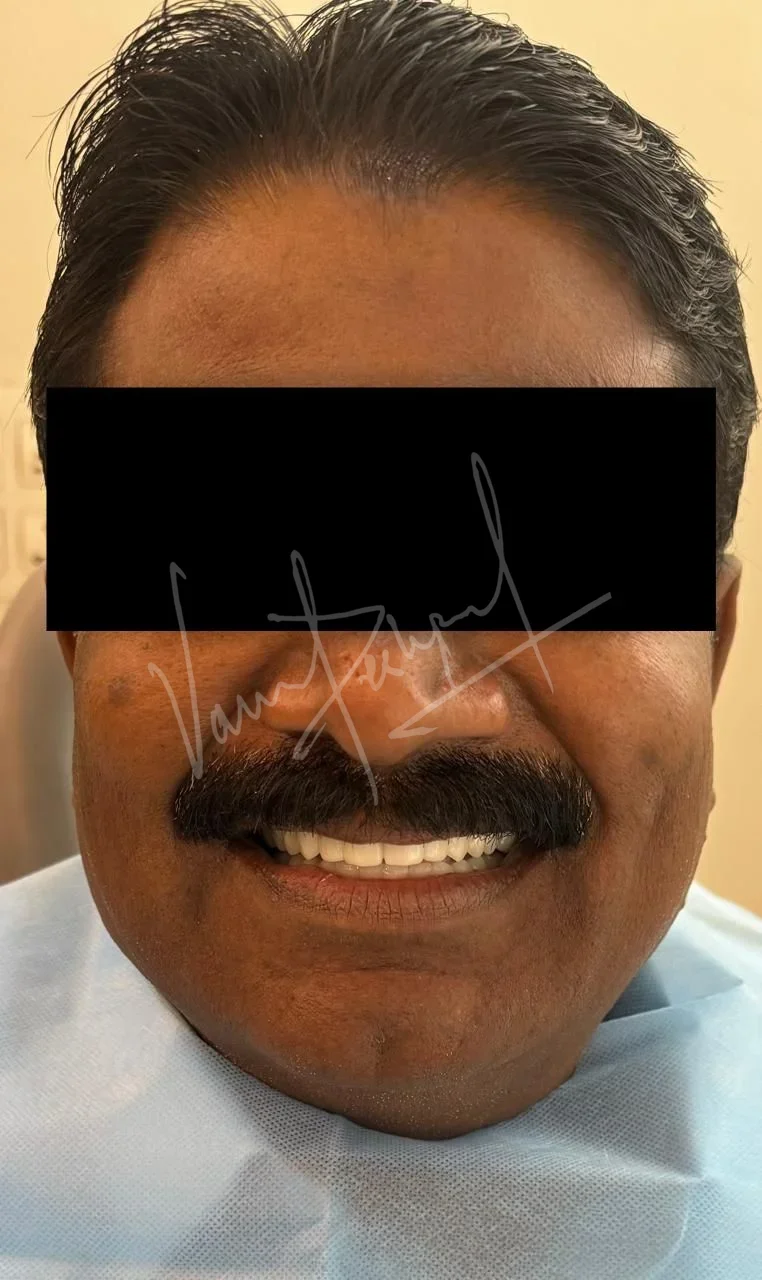 Full Mouth Rehabilitation using Zirconia Monolithic Prosthesis