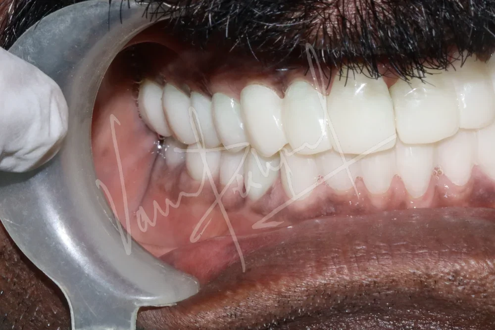 Full Mouth Rehabilitation using Zirconia Monolithic Prosthesis - Image 2