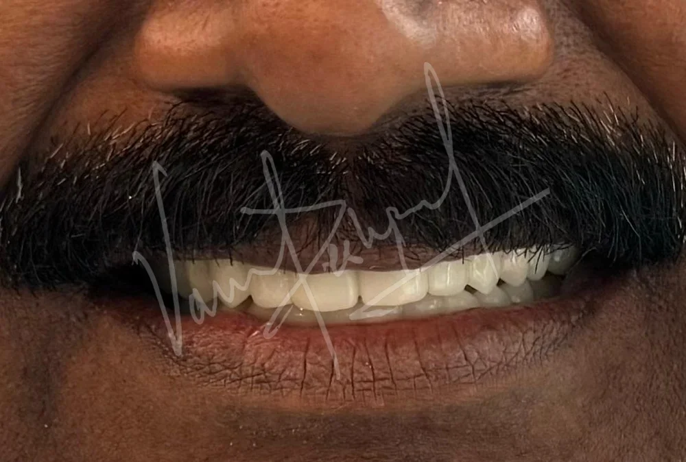 Full Mouth Rehabilitation using Zirconia Monolithic Prosthesis - Image 7