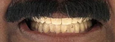 Full Mouth Rehabilitation using Zirconia Monolithic Prosthesis - Image 9