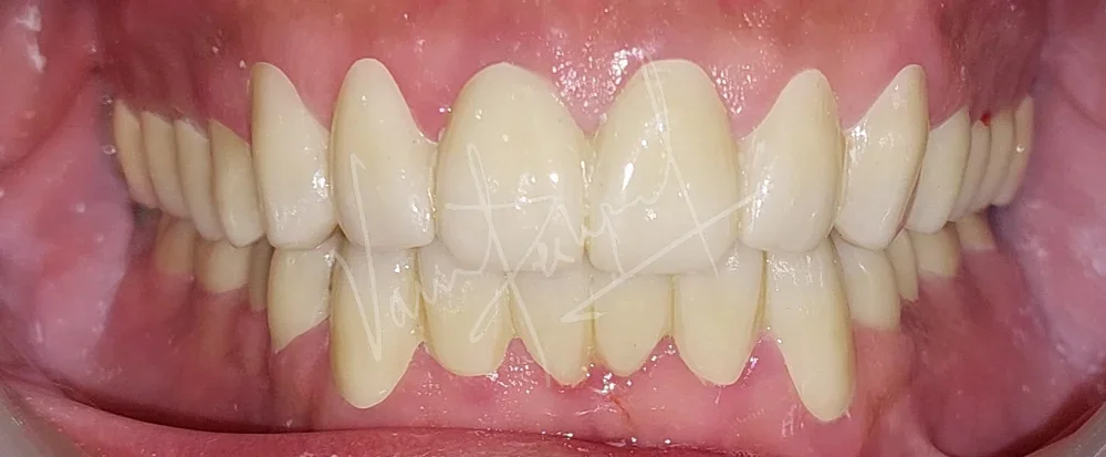 Full Mouth Rehabilitation using Zirconia Prosthesis