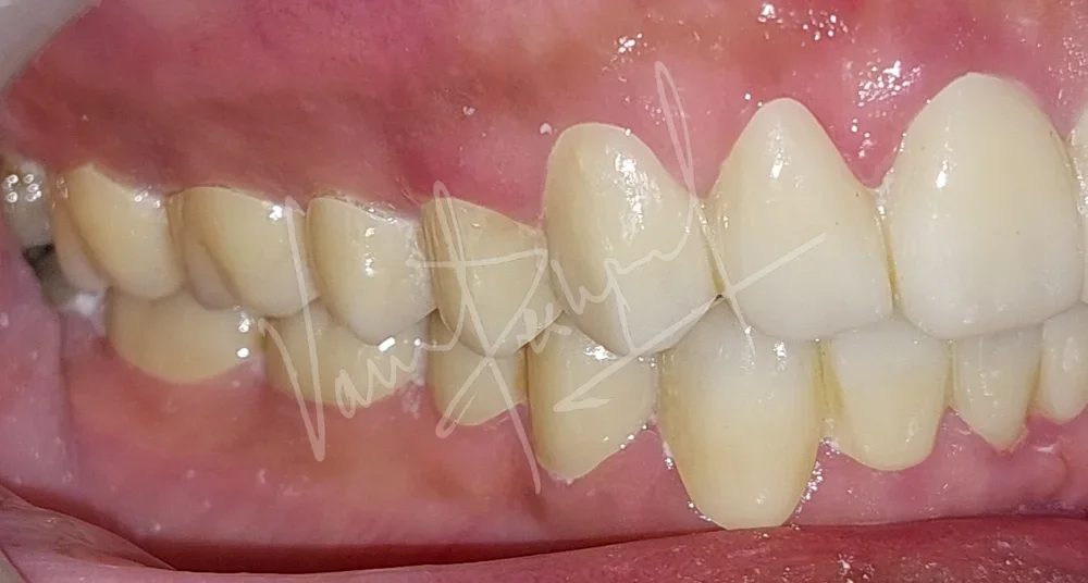 Full Mouth Rehabilitation using Zirconia Prosthesis - Image 12