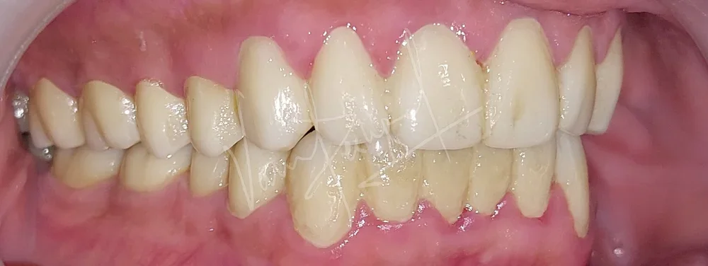 Full Mouth Rehabilitation using Zirconia Prosthesis - Image 16