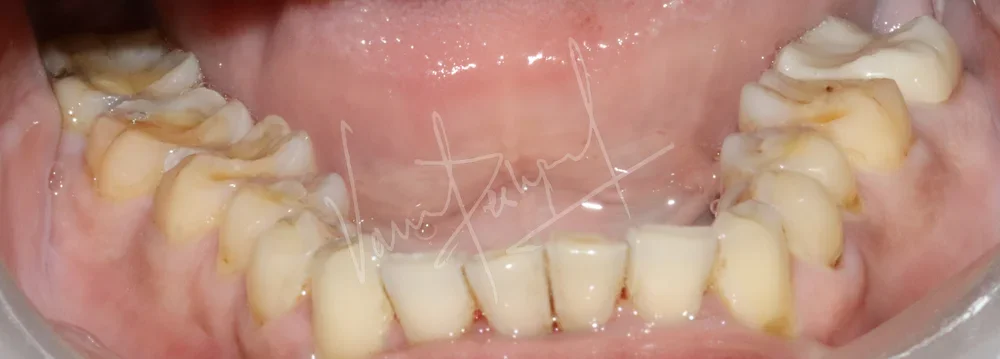 Full Mouth Rehabilitation using Zirconia Prosthesis - Image 3
