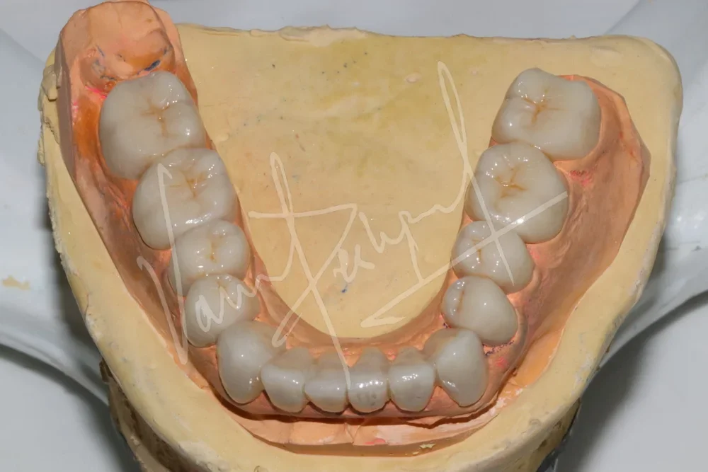 Full Mouth Rehabilitation using Zirconia Prosthesis - Image 5