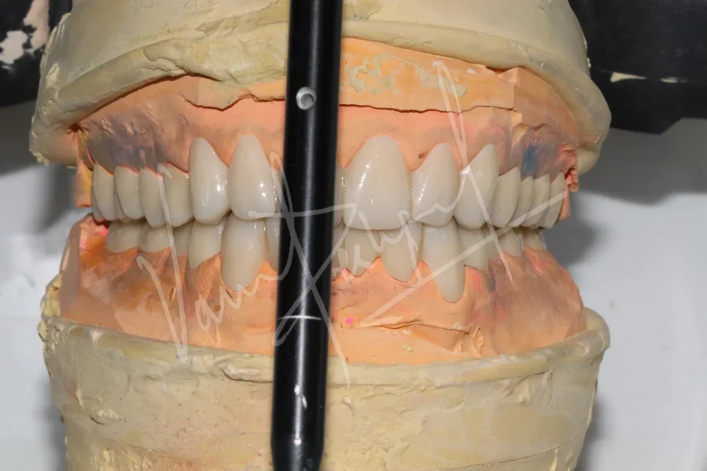 Full Mouth Rehabilitation using Zirconia Prosthesis - Image 6