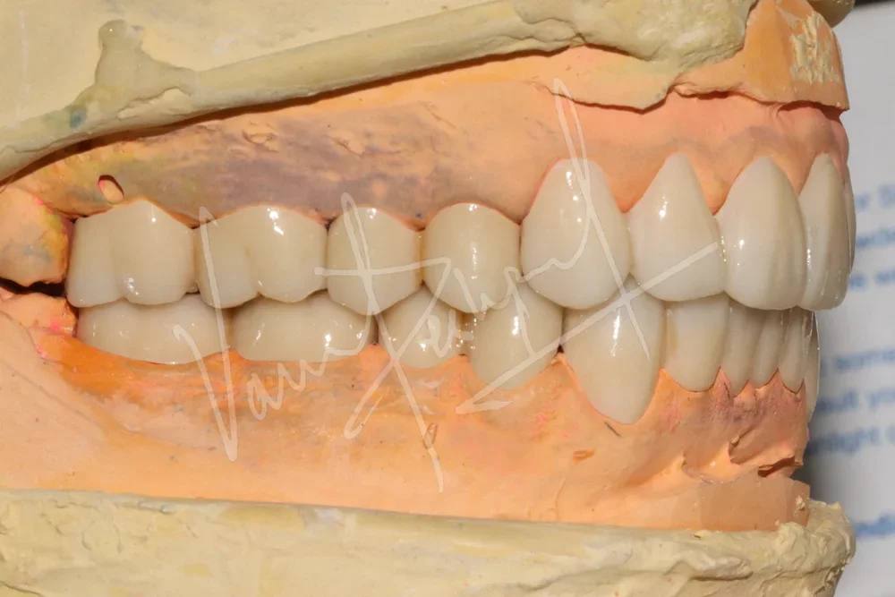 Full Mouth Rehabilitation using Zirconia Prosthesis - Image 8