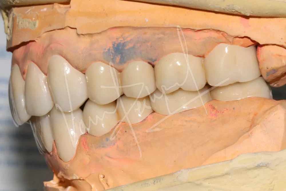 Full Mouth Rehabilitation using Zirconia Prosthesis - Image 9