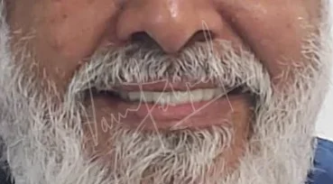 Full Mouth Rehabilitation with Metal Ceramic Prosthesis