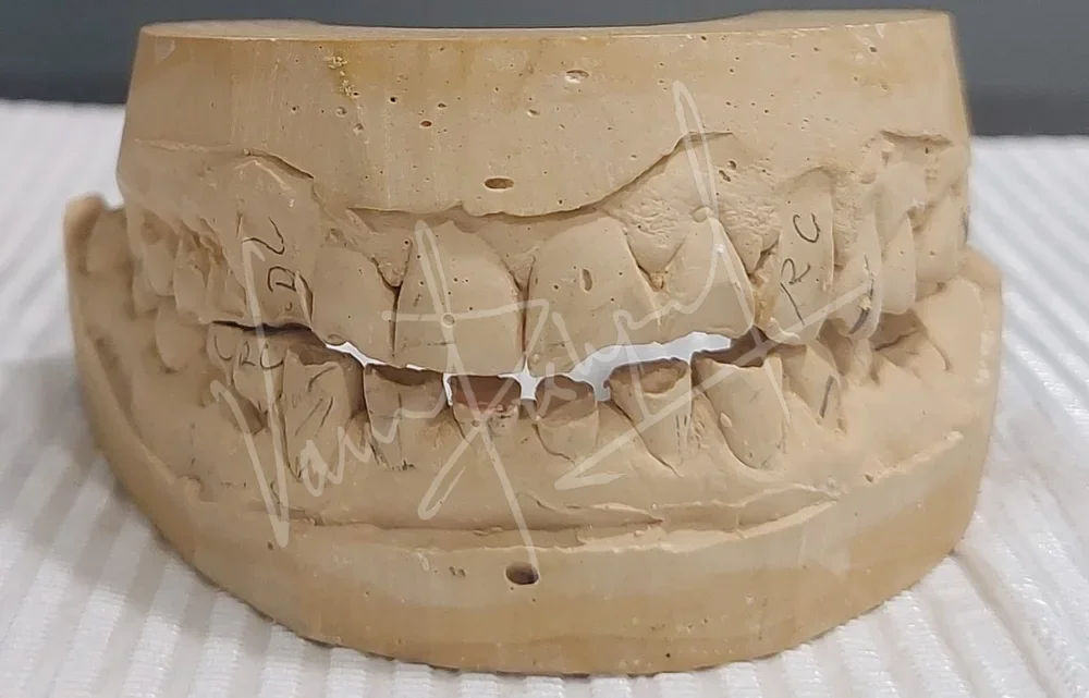 Full Mouth Rehabilitation with Metal Ceramic Prosthesis - Image 2