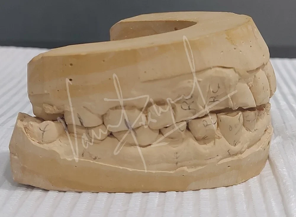 Full Mouth Rehabilitation with Metal Ceramic Prosthesis - Image 3